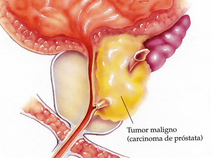tumor na prostata benigno