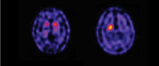 Cintilografia Cerebral com TRODAT