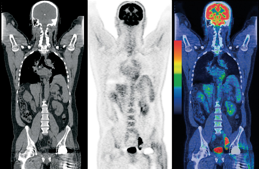 PET-CT | IMEB