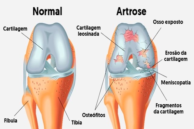 Artrose
