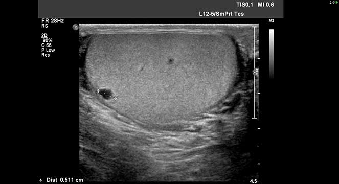 Ecografia Da Bolsa Escrotal Imeb