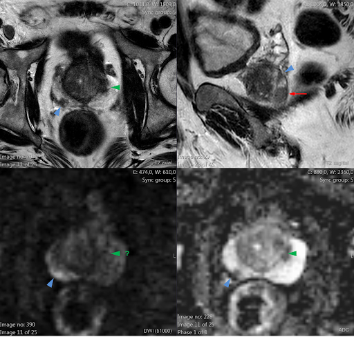 Lesão nodular na zona periférica direita com extensão extracapsular (seta vermelha) – com hipossinal T2 (imagem 1), curva de realce dinâmico positiva (imagem 2) e restrição à difusão (imagens 3 e 4). PI-RADS 5 – Muito alta probabilidade de neoplasia clinicamente significante. Lesões nodulares prostáticas (setas) com hipossinal T2 (imagens 1 e 2) e restrição à difusão (imagens 3 e 4), sem extensão extracapsular. PI-RADS 4 – Alta probabilidade de neoplasia clinicamente significante.