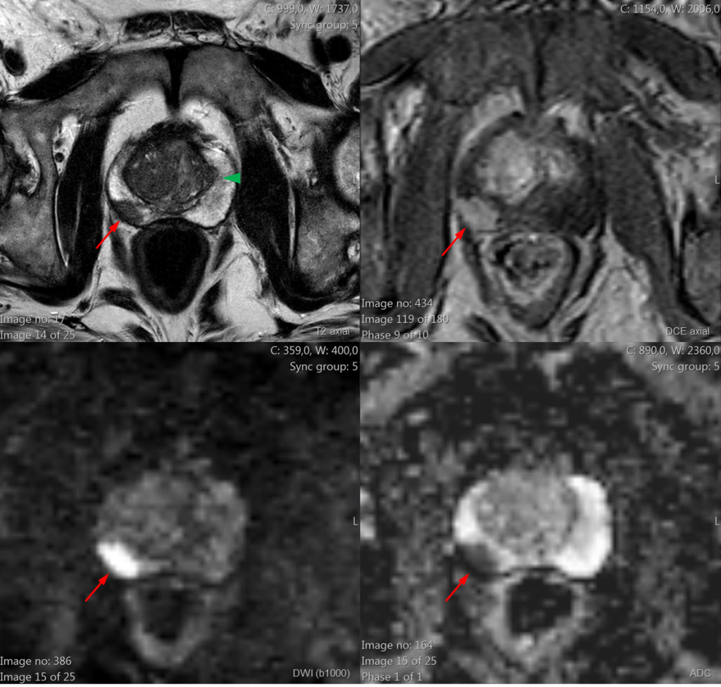 Ressonância Magnética Multiparamétrica da Próstata
