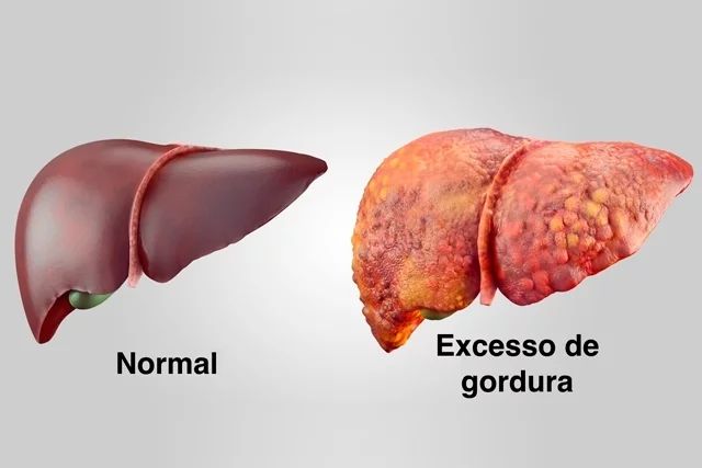 gordura no figado sintomas